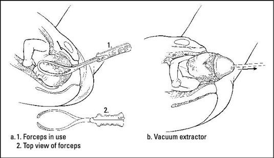 Photographie - Aider la nature: l'accouchement vaginal opératoire