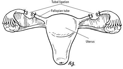 Découpe et ligaturer les trompes de Fallope empêcher les spermatozoïdes d'atteindre l'ovule.