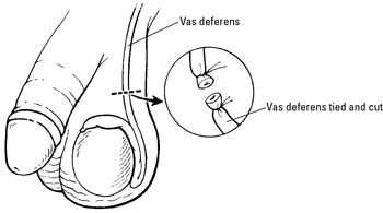 Dans une vasectomie, les tubes qui transportent les spermatozoïdes sont coupées et attachées.