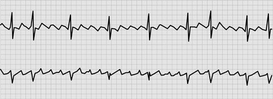Troubles de la conduction cardiaque couverts sur le médecin assistant examen