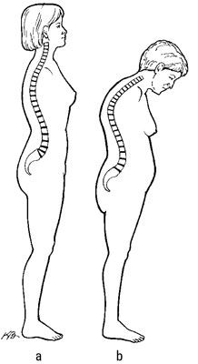 Une colonne vertébrale normale (a) et une douairière's hump (b).